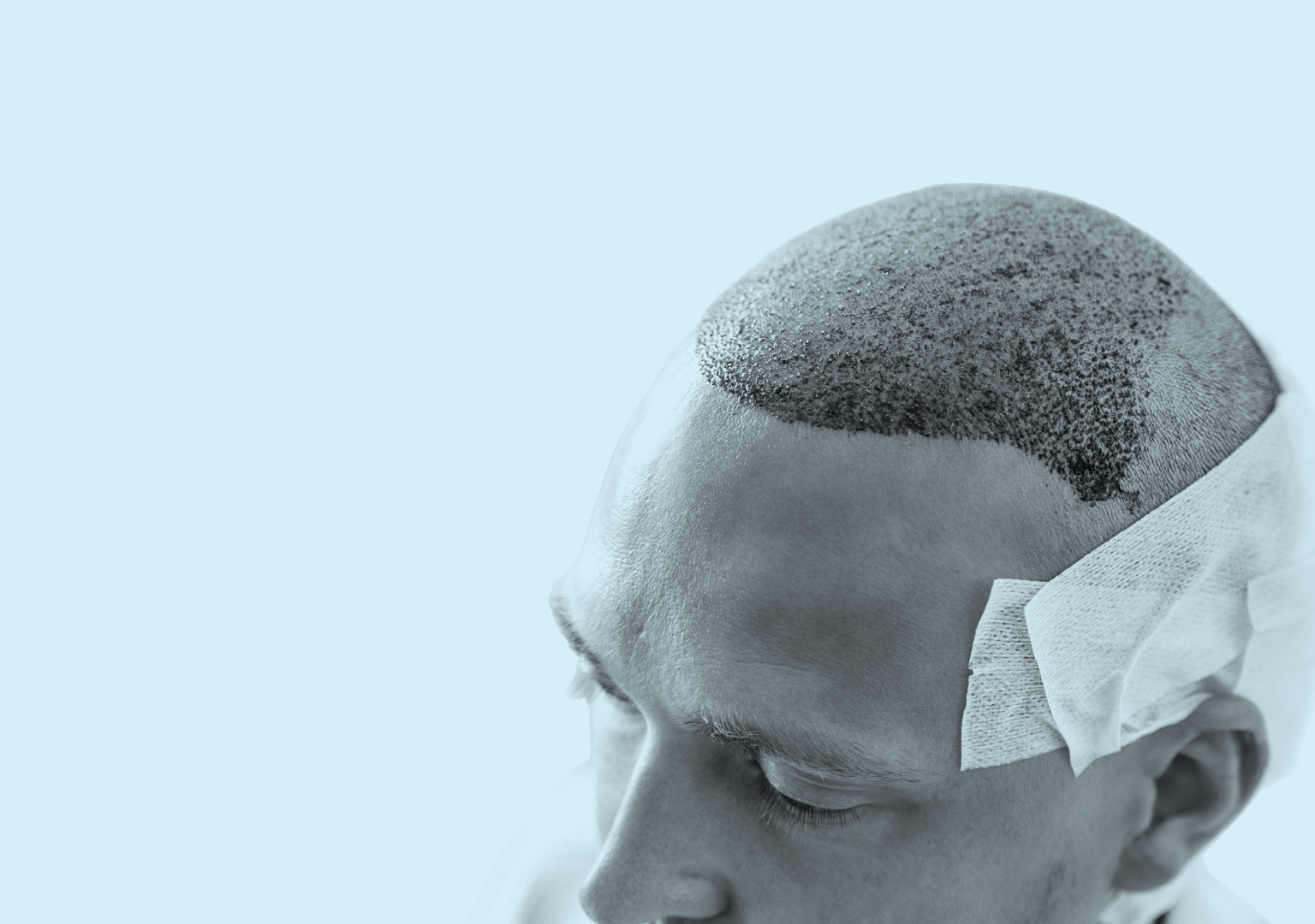 When Are Hair Transplant Grafts Secure? (Day-by-Day Guide)