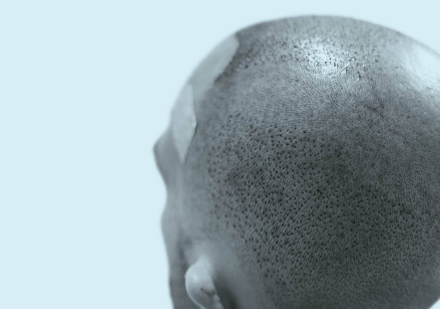 Tightness and Dryness After Hair Transplant: Why It Happens and What’s Normal