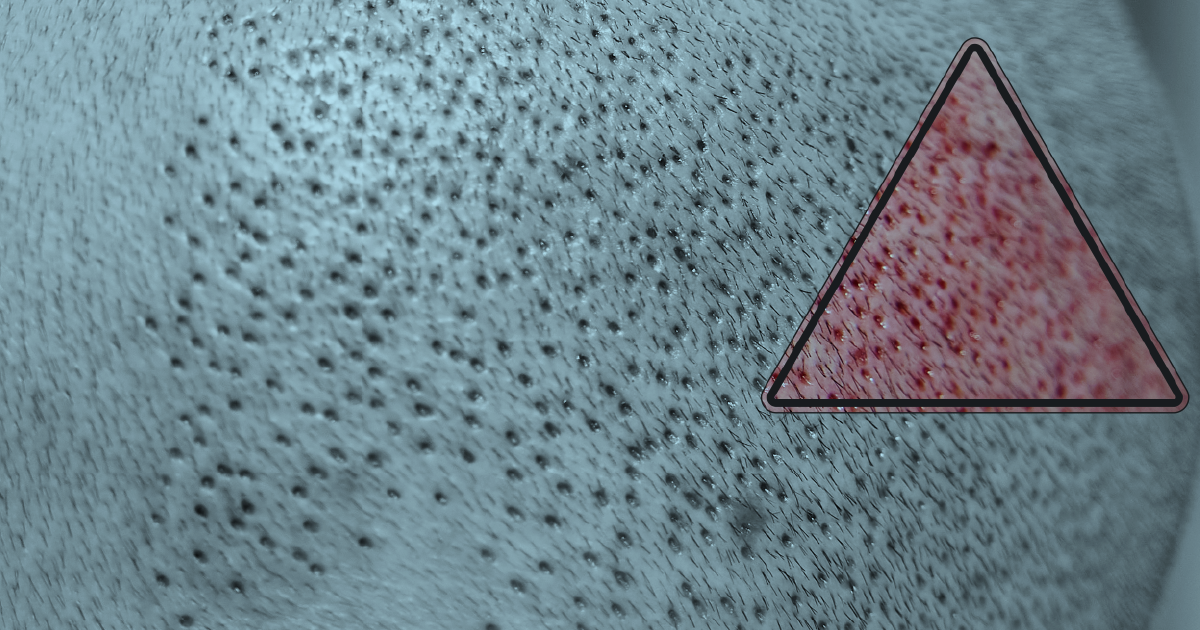 Redness After a Hair Transplant How Long It Lasts and When It Fades