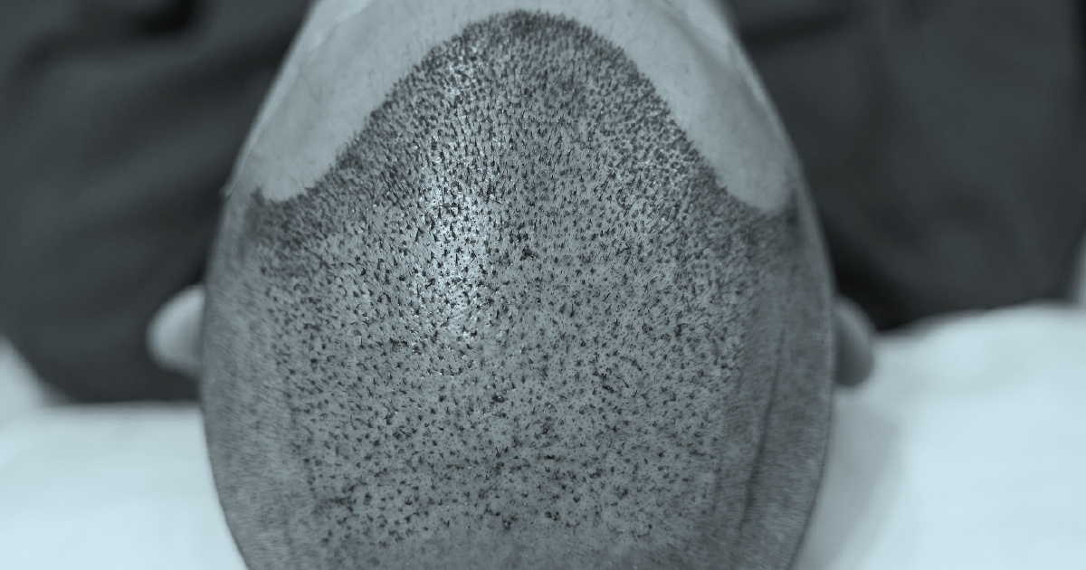 How to Sleep After a Hair Transplant Positions, Pillows and the First 10 Nights